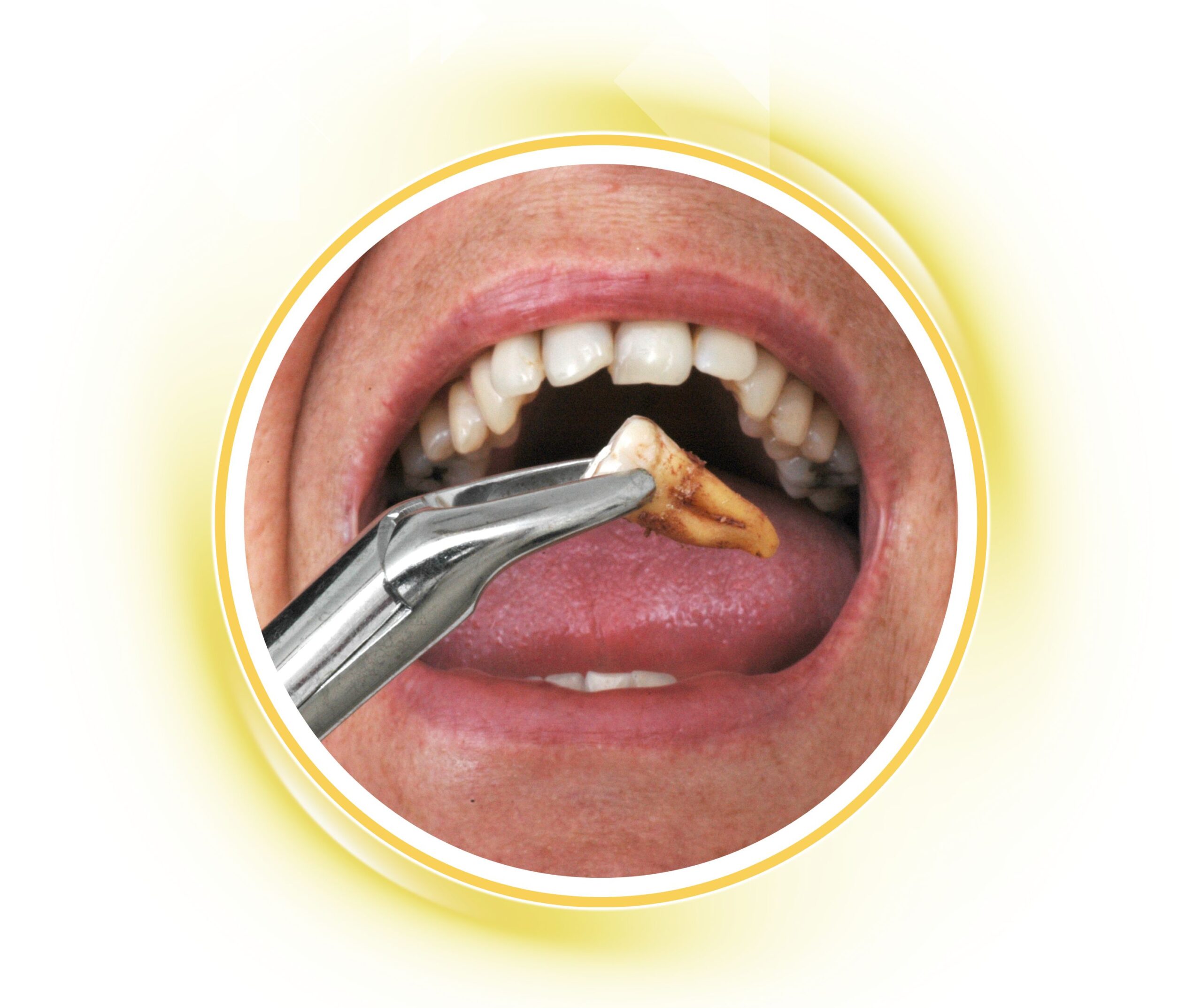 Quy trình nhổ răng hư, răng bị nhiễm trùng bằng dụng cụ chuyên dụng tại Nha khoa Phương Thành