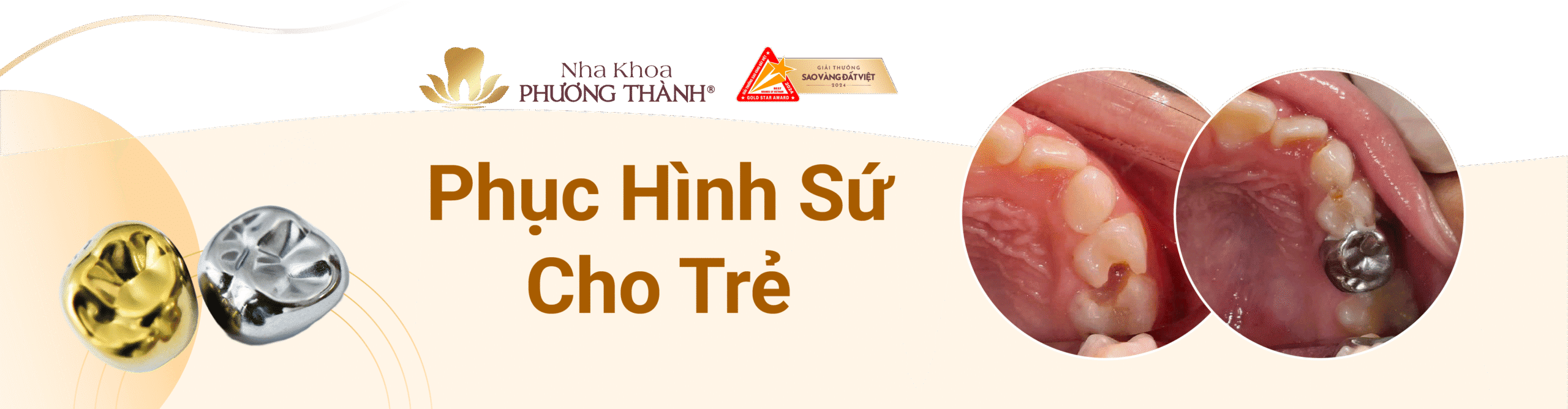 Banner quảng cáo dịch vụ Phục hình sứ cho trẻ tại Nha khoa Phương Thành