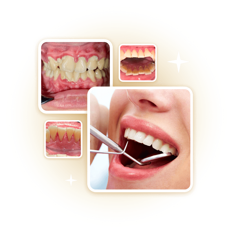 Hình ảnh khách hàng cạo vôi răng, điều trị viêm lợi và nha chu tại Nha khoa Phương Thành