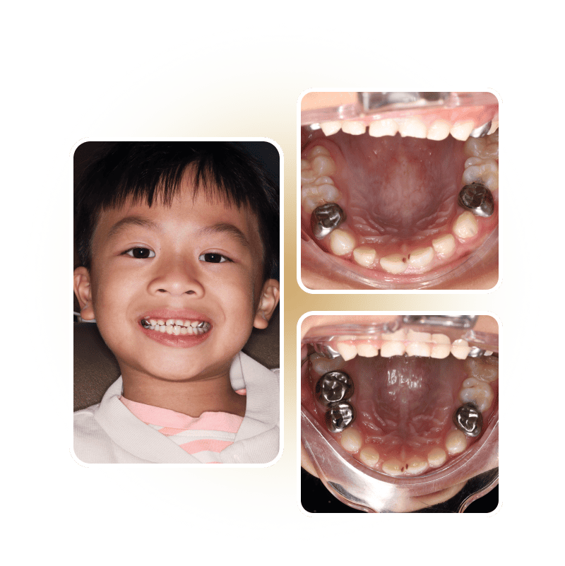 Kết quả phục hình, bọc mão thép không gỉ cho răng sữa của bé tại Nha khoa Phương Thành