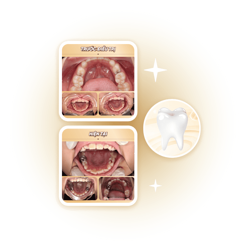 Phục hồi răng trẻ em