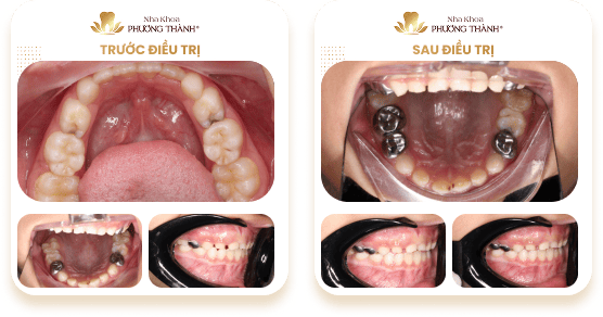 Ảnh so sánh trước và sau điều trị bọc mão thép không gỉ (răng bọc kim loại) cho răng sữa tại Nha khoa Phương Thành
