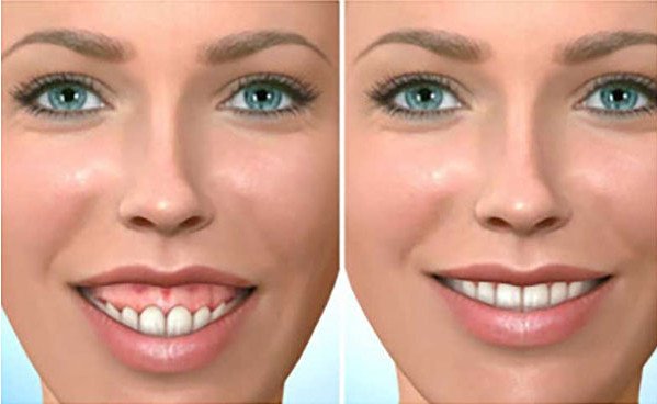 Ảnh so sánh trước và sau điều trị cười hở lợi, cắt lợi thẩm mỹ tại Nha khoa Phương Thành