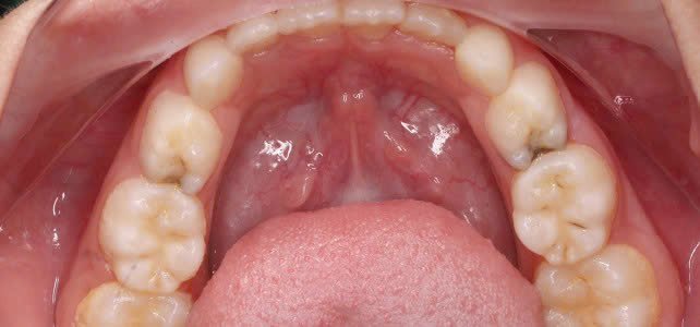 Hình ảnh tình trạng răng hàm trên bị sâu và mòn, cần trám răng tại Nha khoa Phương Thành