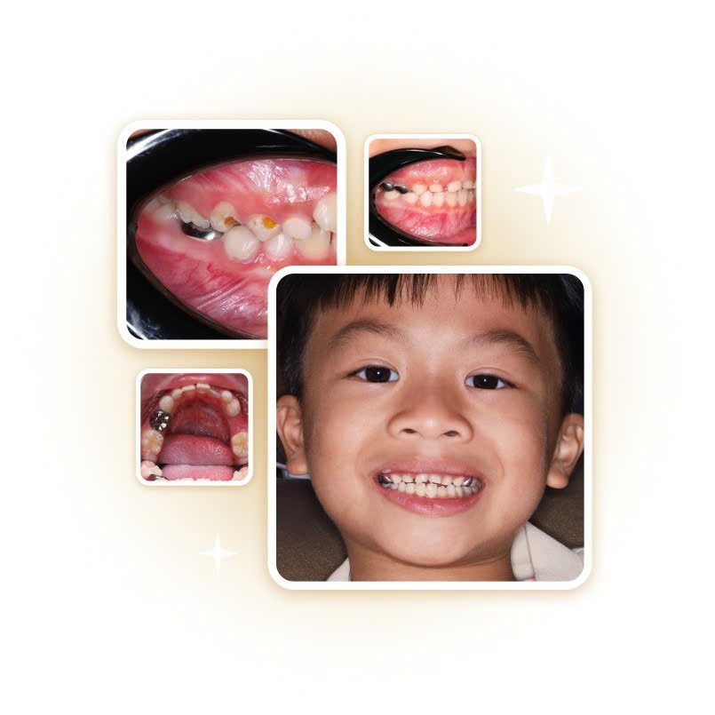 Hình ảnh kết quả điều trị răng sâu, chỉnh nha dự phòng và chăm sóc răng miệng cho bé tại Nha khoa Phương Thành