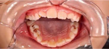 Tình trạng răng sâu, mòn răng và vỡ miếng trám cũ cần điều trị tại Nha khoa Phương Thành