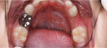 Kết quả phục hình, bọc mão thép không gỉ cho răng sữa của bé tại Nha khoa Phương Thành